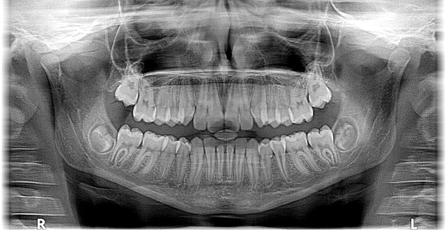rentgen zubů